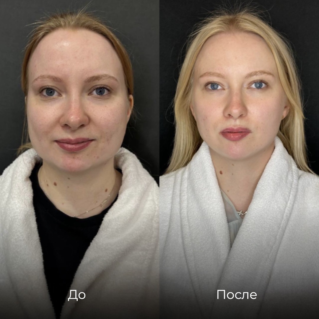 SMAS-лифтинг Ultraformer MPT