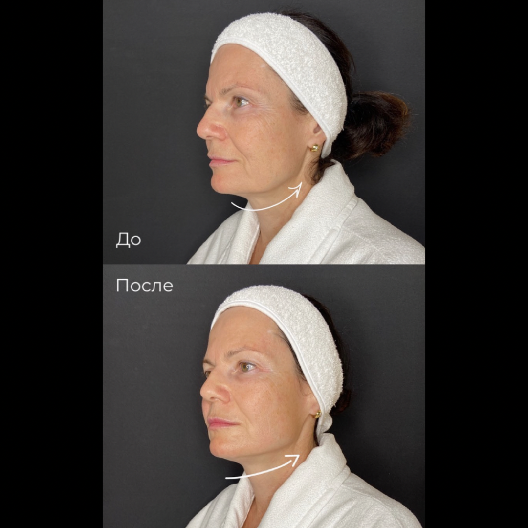 SMAS-лифтинг Ultraformer MPT