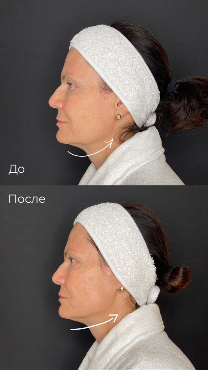 SMAS-лифтинг Ultraformer MPT