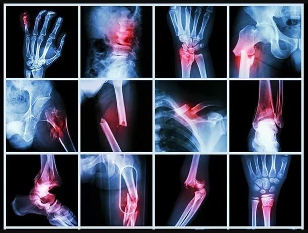 #реабилитация #травмы #операция #перелом