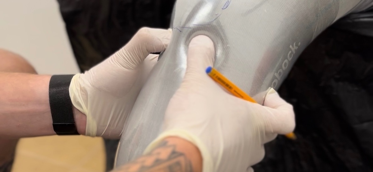 Снятие слепка для протеза голени