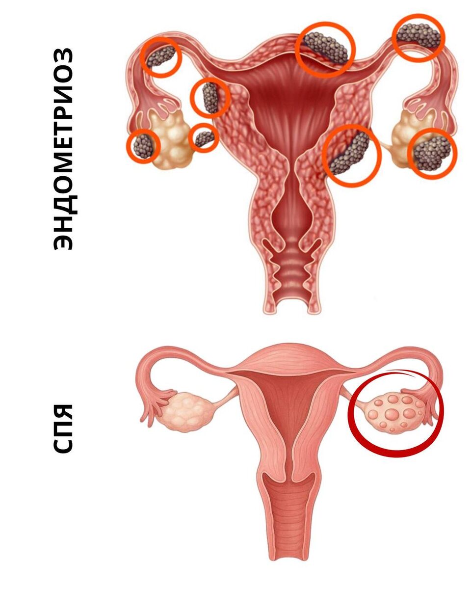 Эндометриоз и СПЯ – что общего?