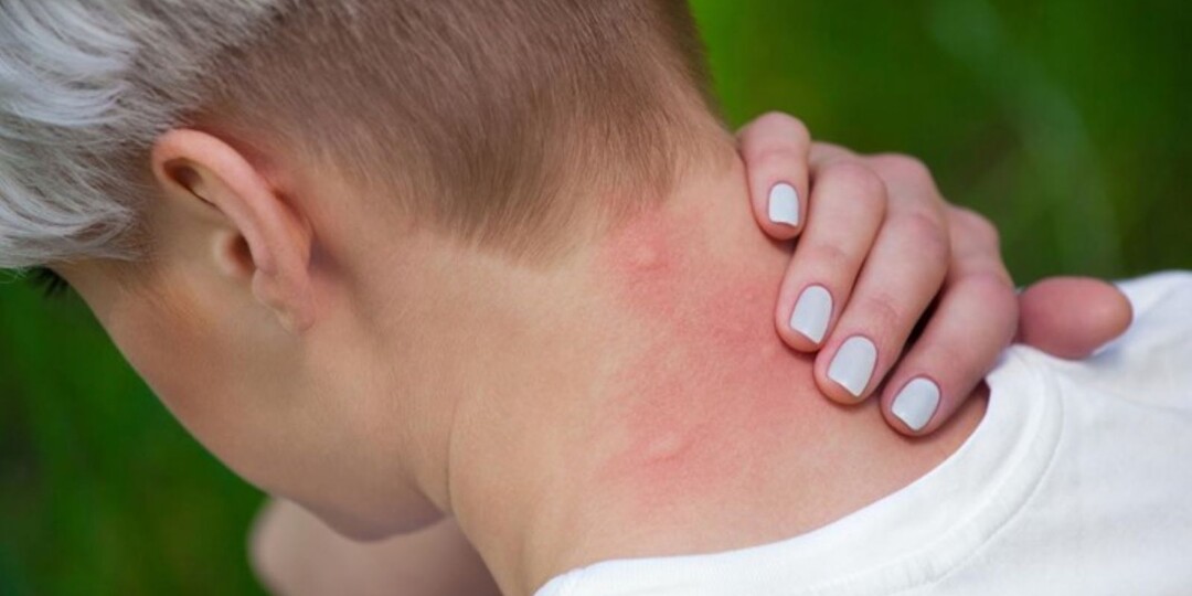 Аллергия на постельных клопов у человека