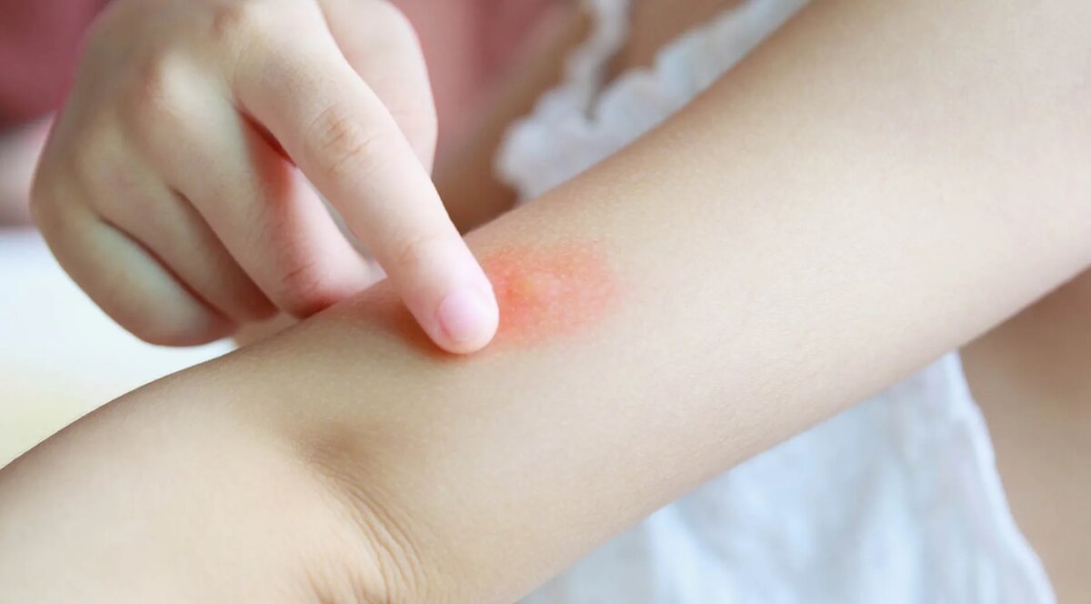 Аллергия на коже от укуса клопов