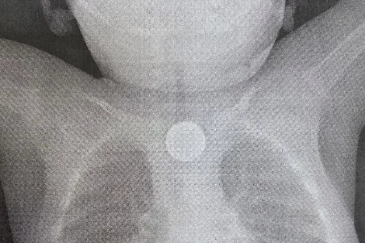    Бригада врачей с помощью эндоскопии вытащила из пищевода ребёнка двухрублёвую монету и дисковую литиевую батарейку.