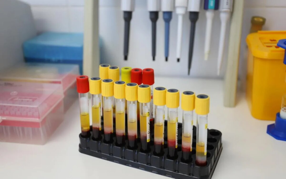    Свыше 470 новых случаев ВИЧ выявили в Удмуртии в 2025 году