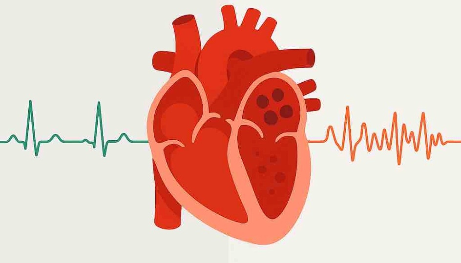 «Сердце сбивается с ритма»: что такое мерцательная аритмия — просто, честно и без паники