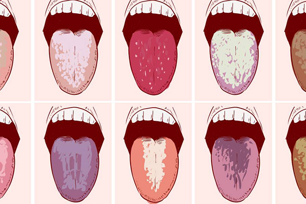 Налёт на языке — что он рассказывает, если научиться слушать