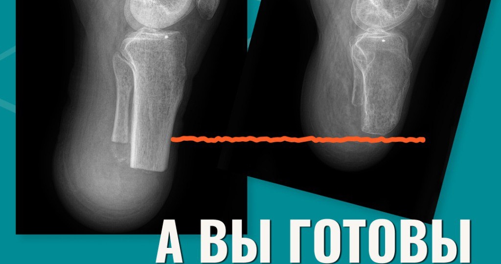 Протезирование без врачей. Готовы к рискам?