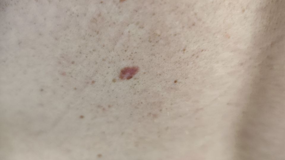 Меланома нулевой стадии: диагноз, который лучше услышать вовремя