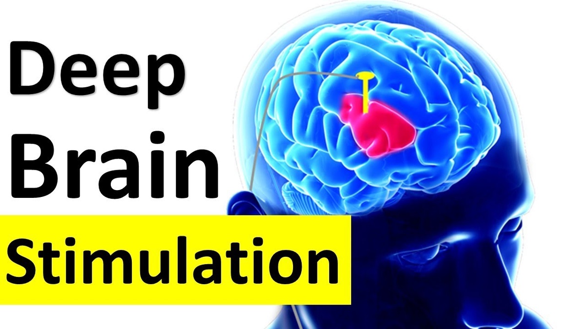 Глубокая стимуляция мозга. Фото: Aman Scрarma