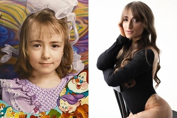 Анна столкнулась с бедой в пять лет. Фото: личный архив.