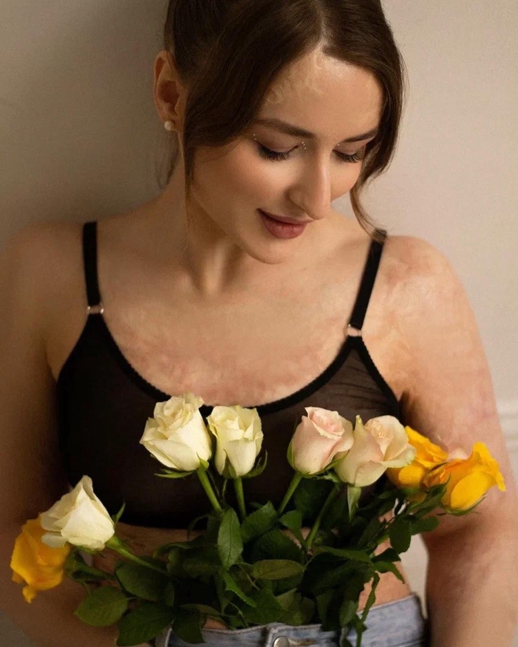 Анне сделали операцию по пересадке кожи. Фото: личный архив