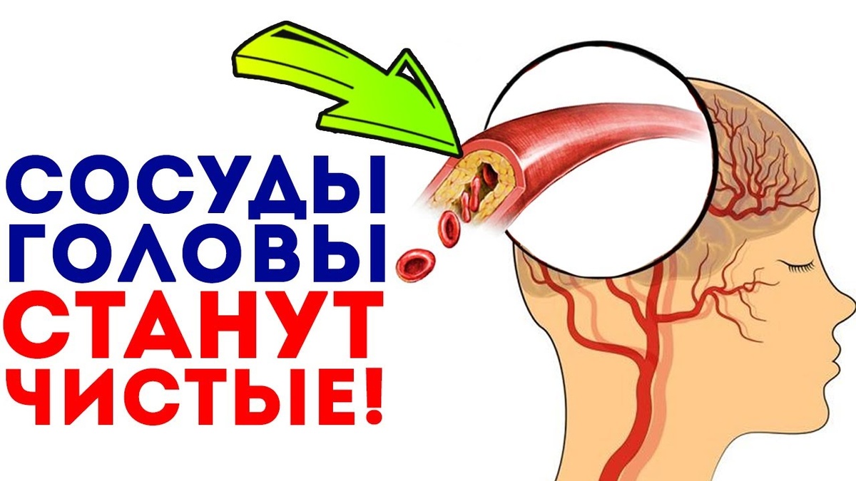 6 Симптомов, Что СОСУДЫ Мозга Теряют Проходимость (чек-лист)
