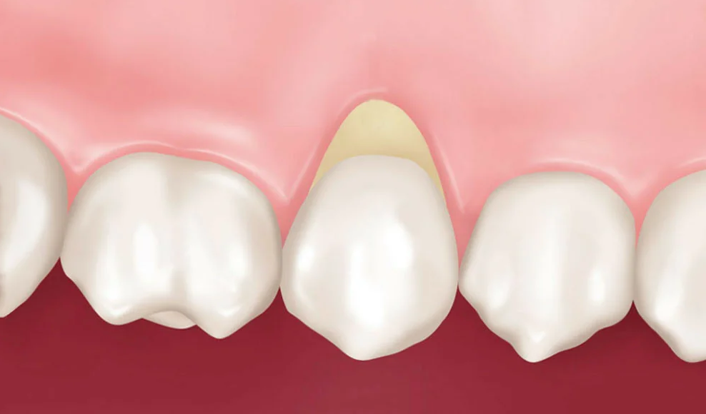 Клиновидный дефект десен