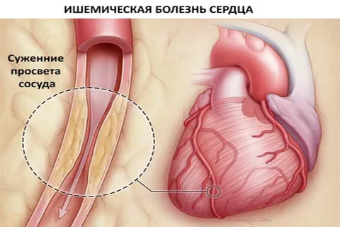Как распознать и остановить ишемическую болезнь сердца до беды