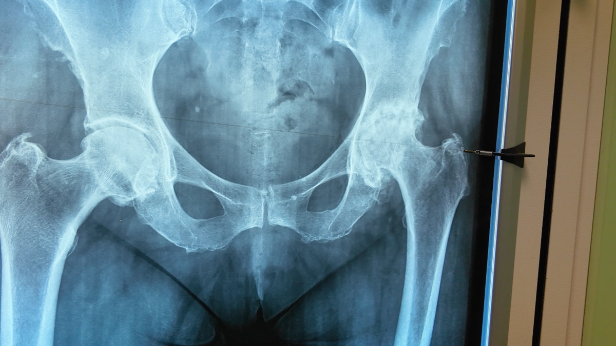 До операции. Разрушение тазобедренного сустава на снимке справа.