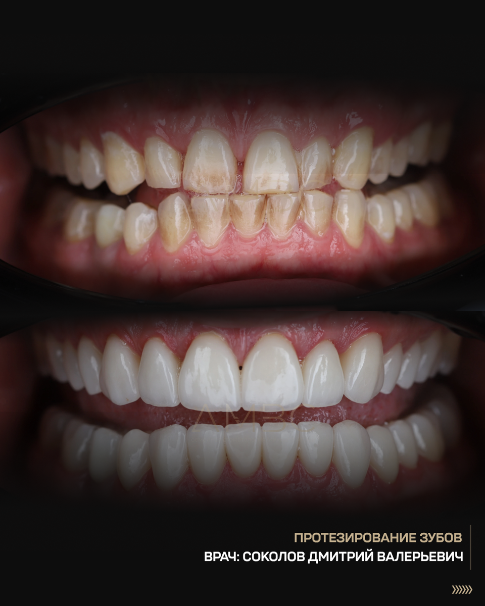 Состояние зубов в момент обращения в стоматологическую клинику и сразу после выполнения эстетической реконструкции