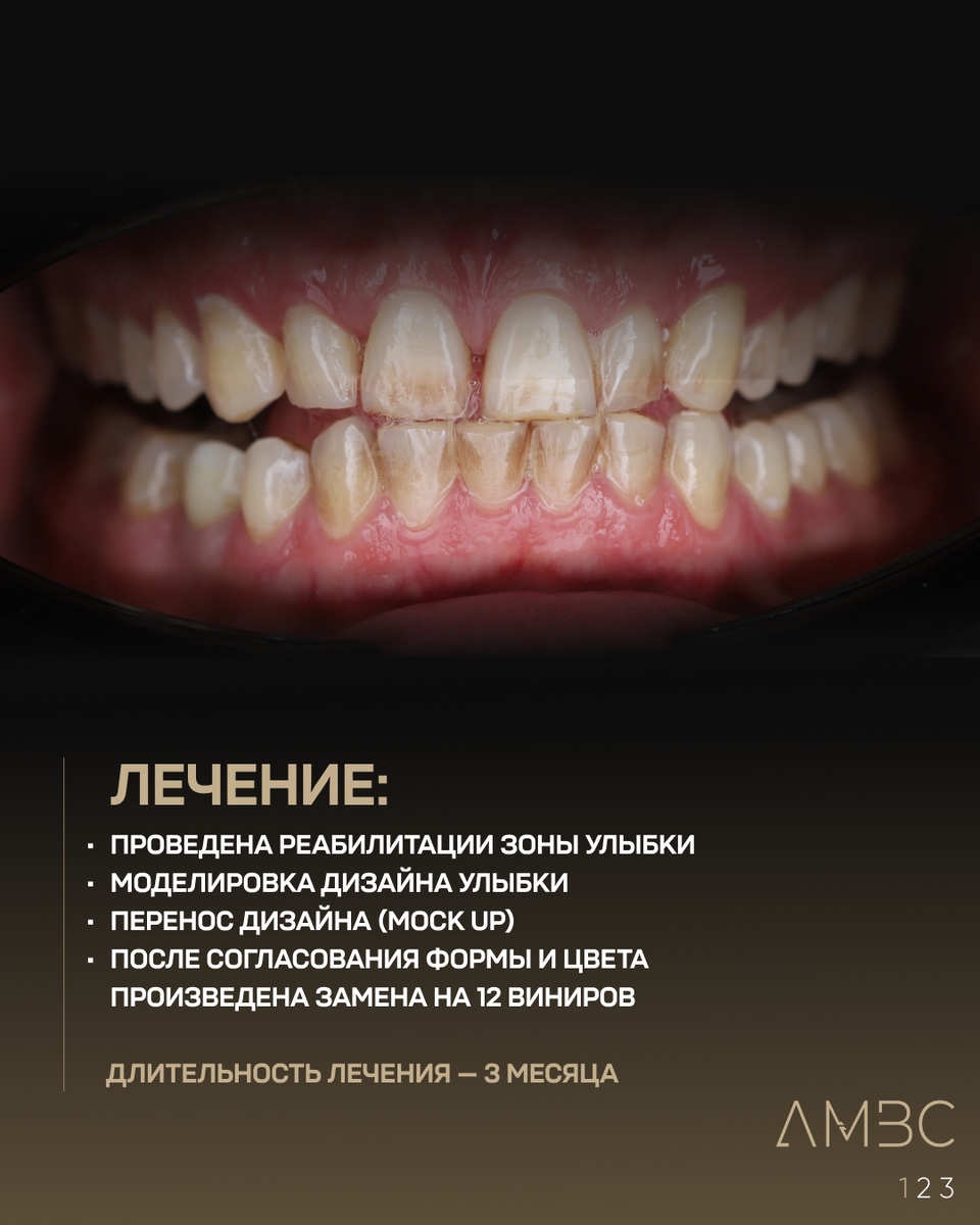 Так как работа затрагивает всю зону улыбки, то мы в обязательном порядке "примерку" улыбки  (Mock-Up). Уже на этом этапе врач, зубной техник и пациент могут представить результат будущей работы, учесть все пожелания пациента и внести корректировки.