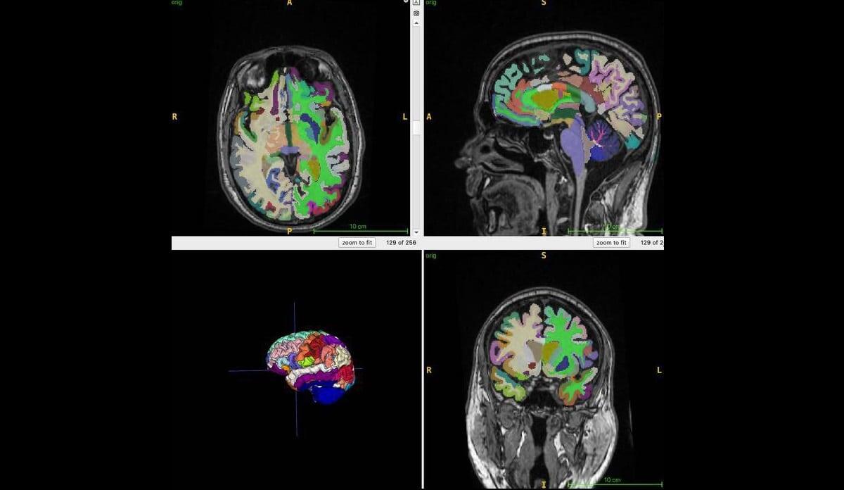    Карта мозга с цветовой кодировкой показывает пример сегментированных объемов отдельных областей, полученных с помощью объемной МРТ 3D T1. Это используется для вычислений возраста мозга с помощью искусственного интеллекта / © Cyrus Raji, RSNA