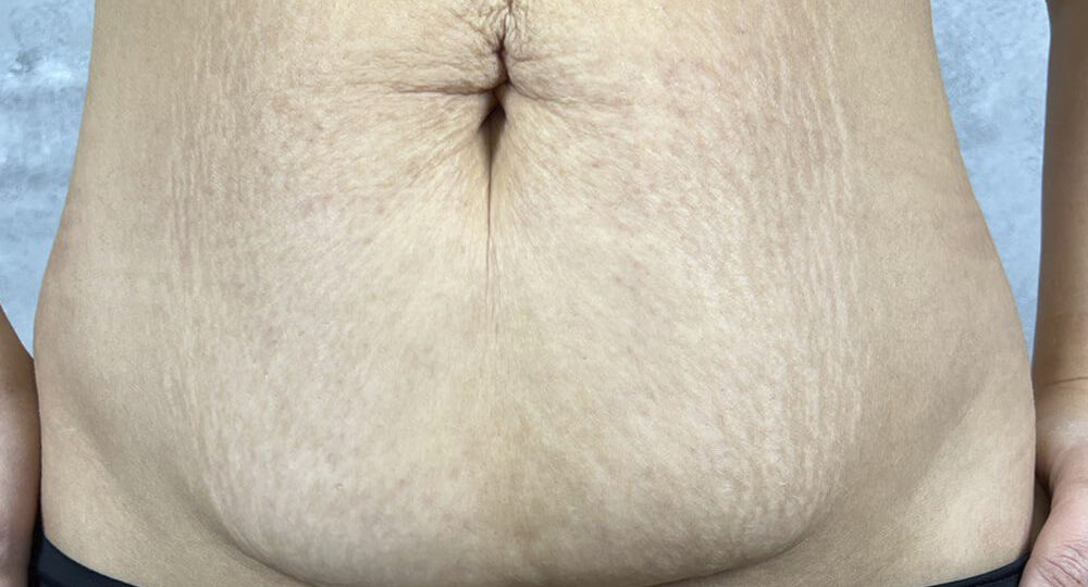 Шов через 14 дней после абдоминопластики