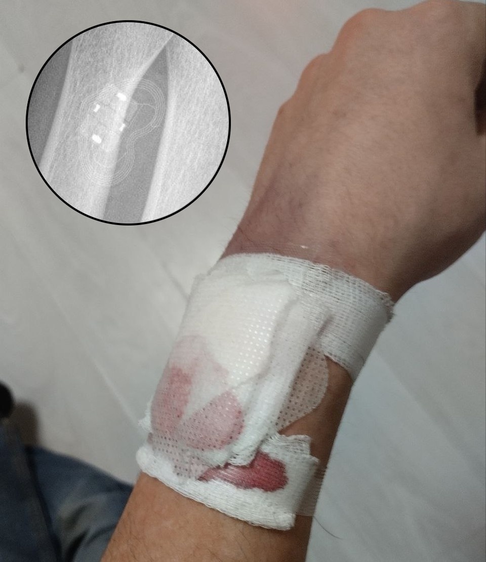    Рука Никиты после операции по вживлению платежного импланта. Фото: предоставлено "КП-Петербург"