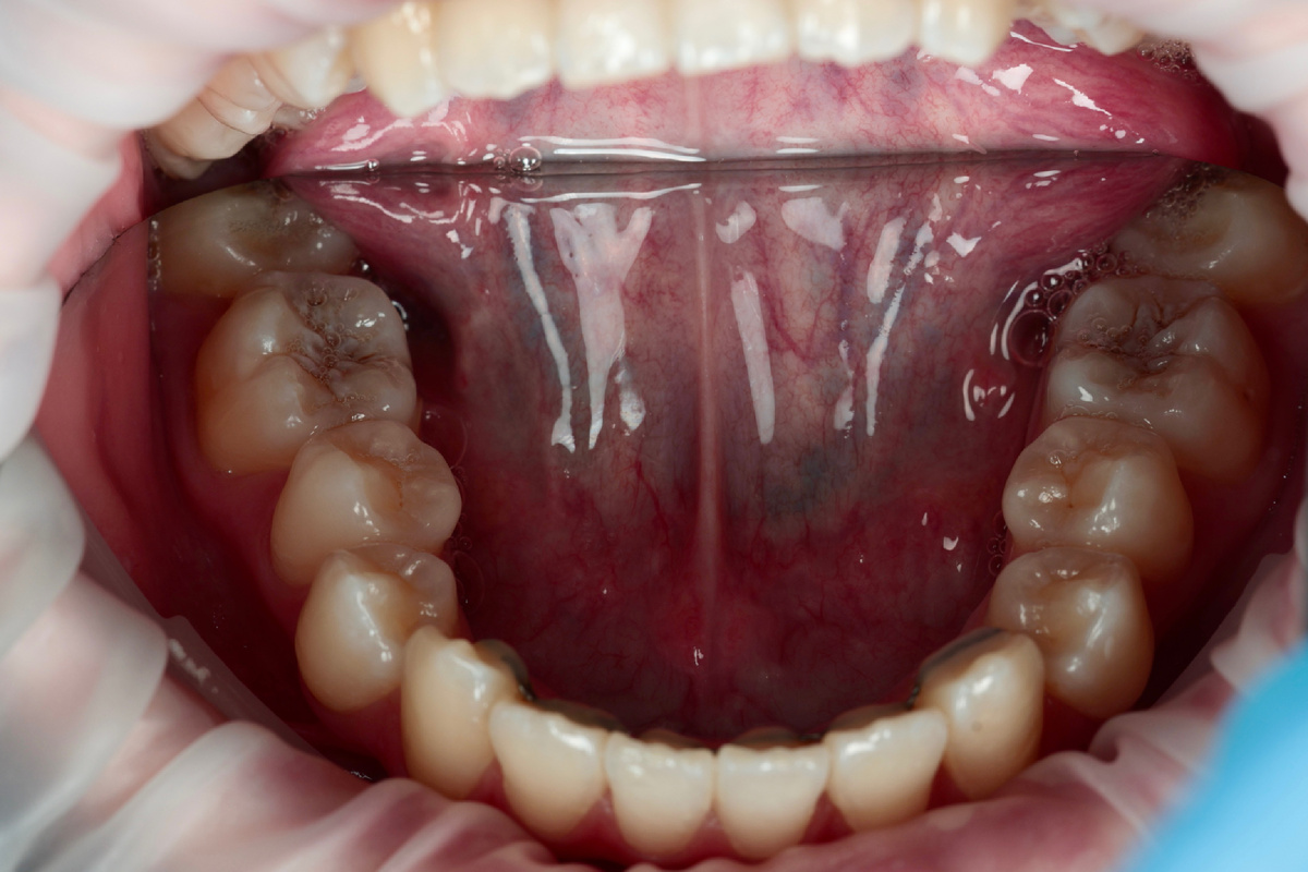 Фото не самое информативное для показа фиссур, но ниже будет видно более отчетливо  