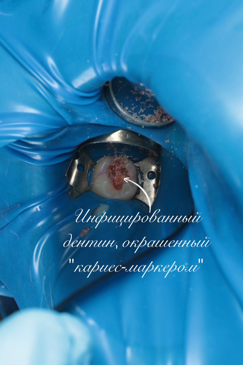 Доступ к изоляции 7 зубов был затруднен из-за неполного прорезывания коронковой части, но мои смогли изолировать 