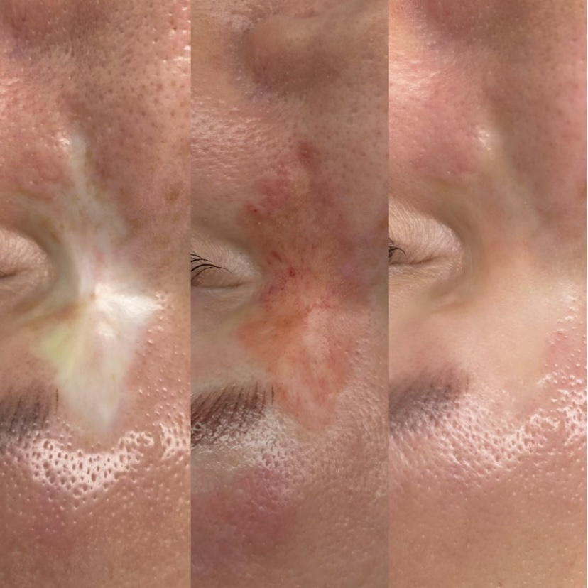 До/Сразу после/Зажившие