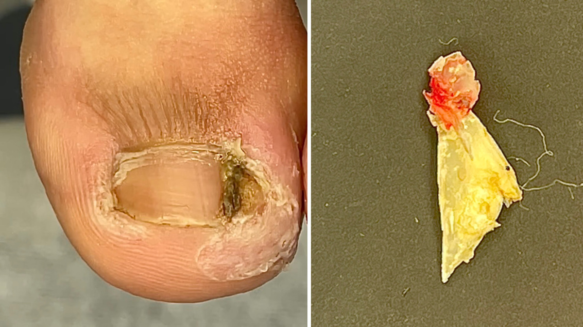 Вросший сегмент