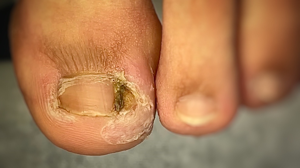 Состояние гнойного воспаления при вросшем ногте