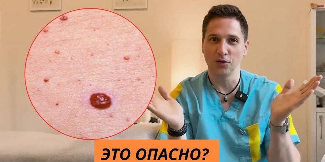 Красные точки на коже: почему они появляются и что скрывают разные виды ангиом