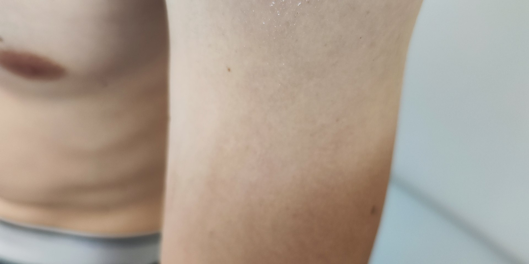 Рак кожи бывает и в 23: как обычный осмотр превратился в спасённую жизнь