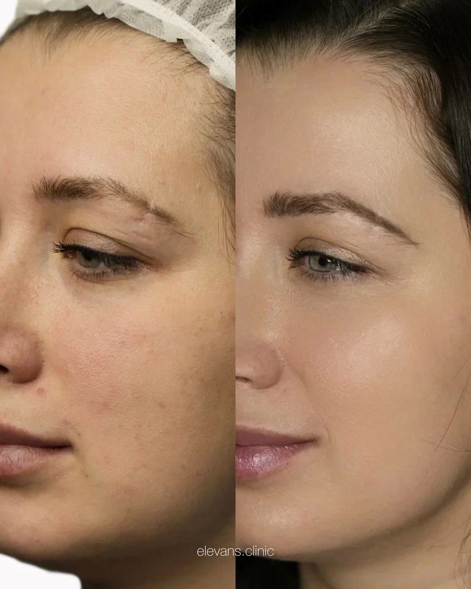 Фото клиента до и после процедуры