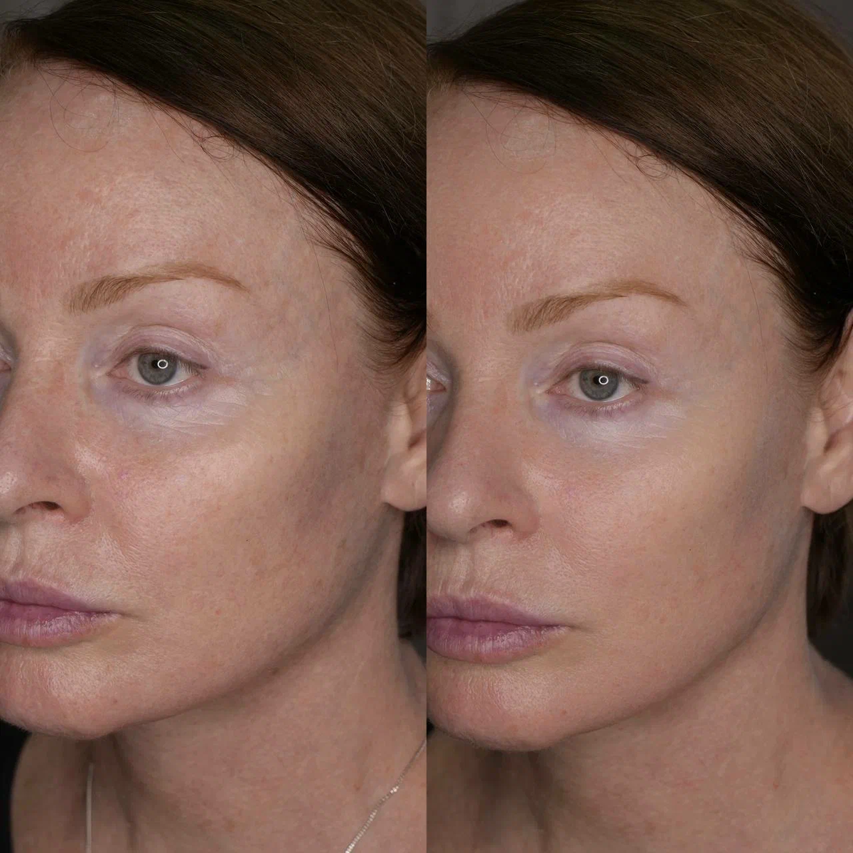 Результат нашего клиента после процедуры