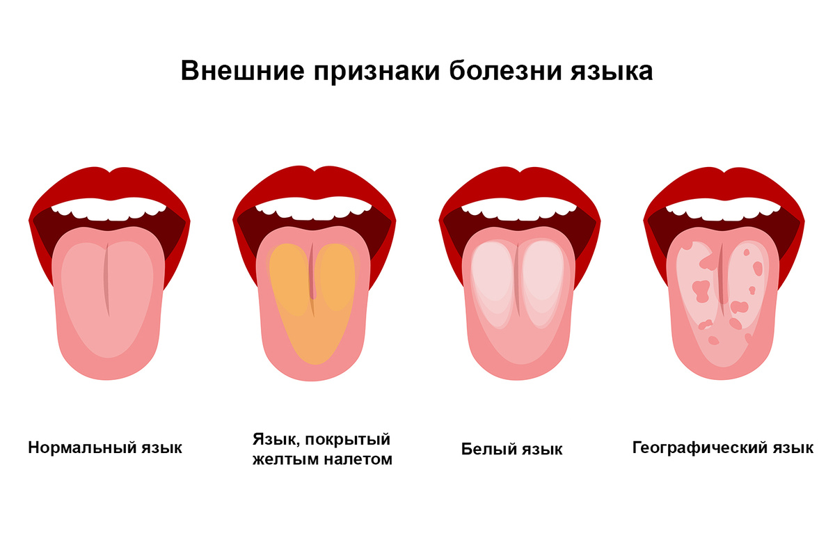 Цвет языка и здоровье: что можно понять за минуту у зеркала