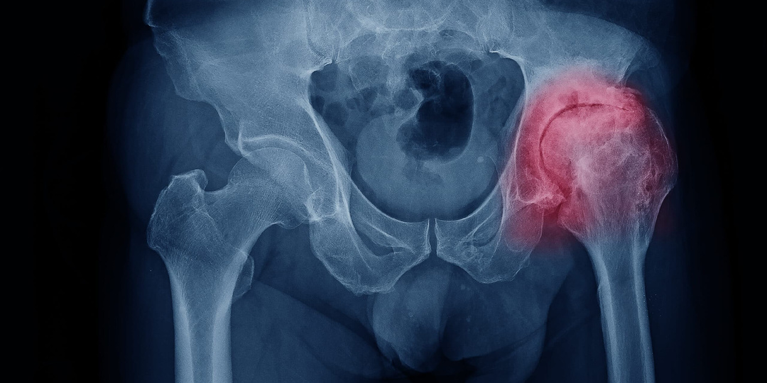 Коксартроз — не повод сдаваться: что реально помогает при боли в тазобедренном суставе?