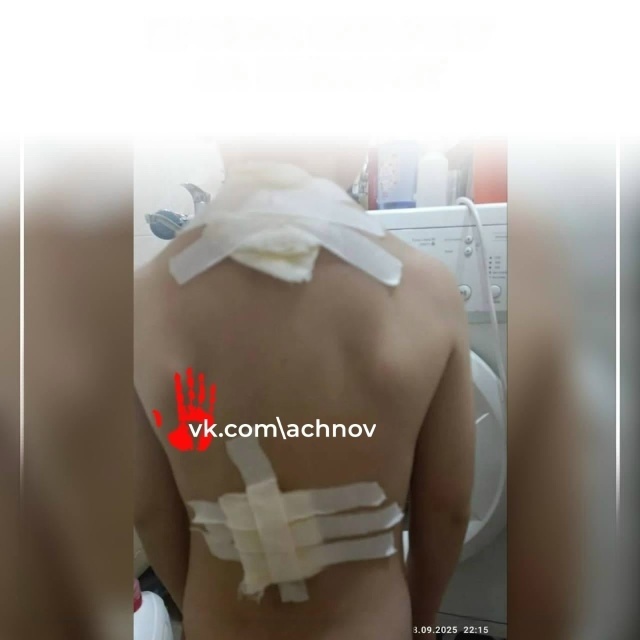 На этих фото - последствия. Ребенок получил ожоги