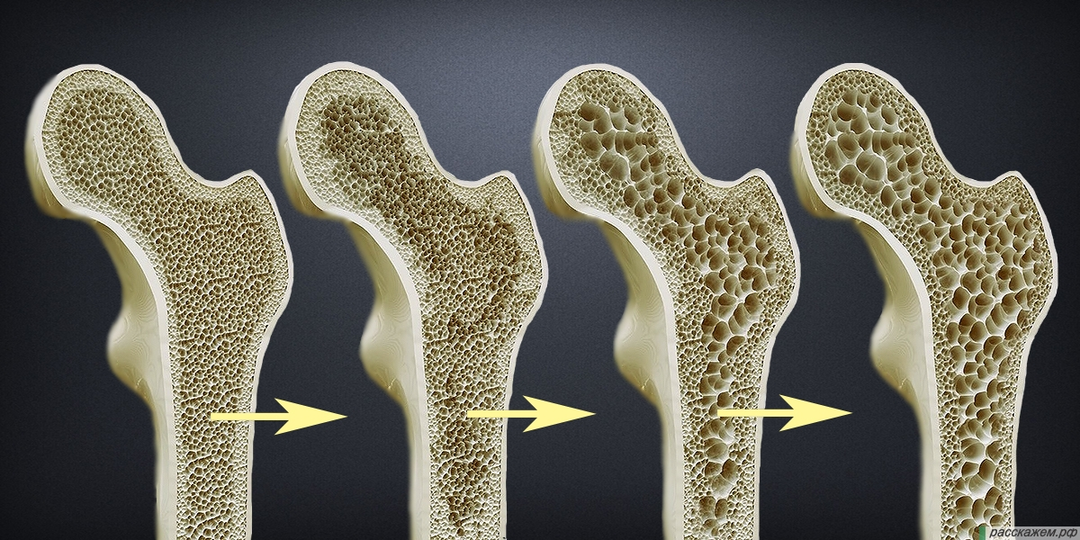 «Безмолвная эпидемия»: откуда берется остеопороз и как помочь своим костям?
