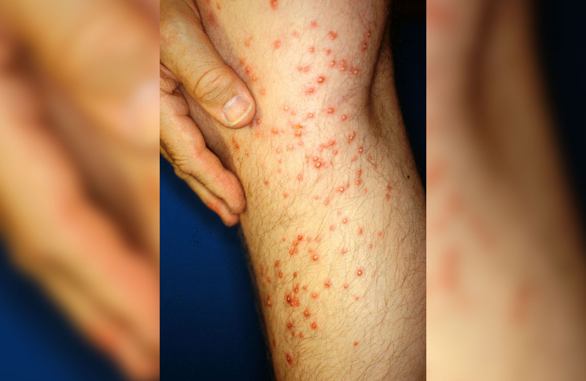    Следы укусов огненных муравьев. Источник фотографии: wikipedia.org