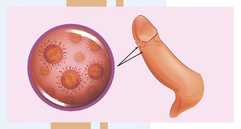 Вирус папилломы человека (ВПЧ) - один из самых распространённых инфекционных агентов, передающихся половым путём