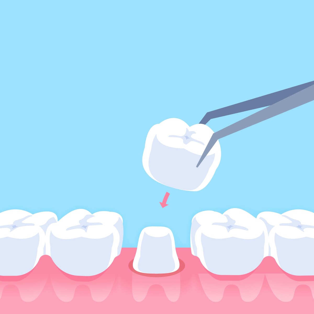 Зубная коронка
