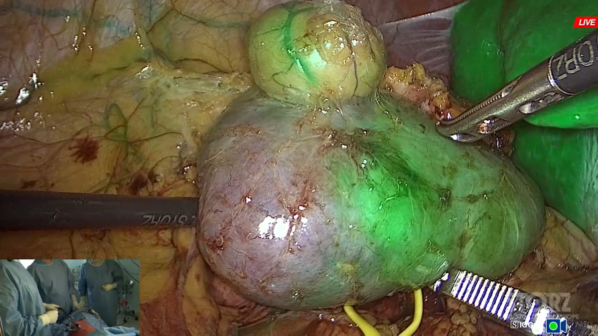 Визуализация кровоснабжаемого участка почки и опухоли с помощью индоцианина зелёного и режима NIR/ICG на видеосистеме RUBINA KARL STORZ