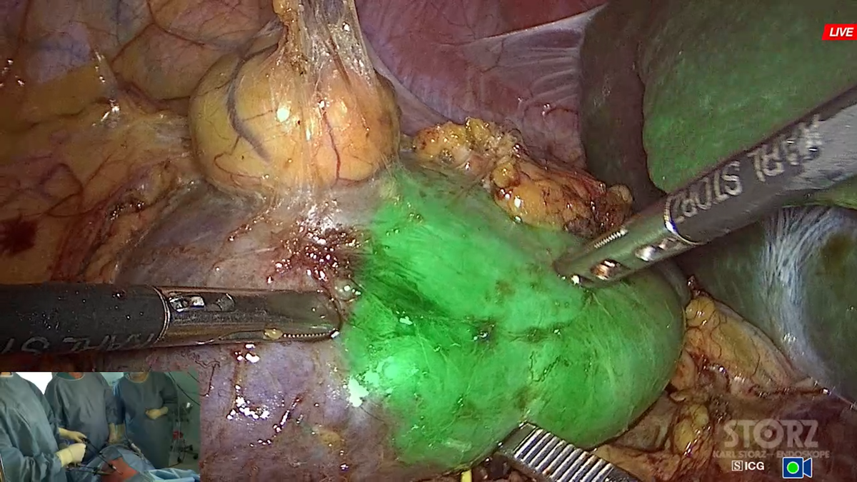 Визуализация кровоснабжаемого участка почки с помощью индоцианина зелёного и режима
NIR/ICG на видеосистеме RUBINA KARL STORZ