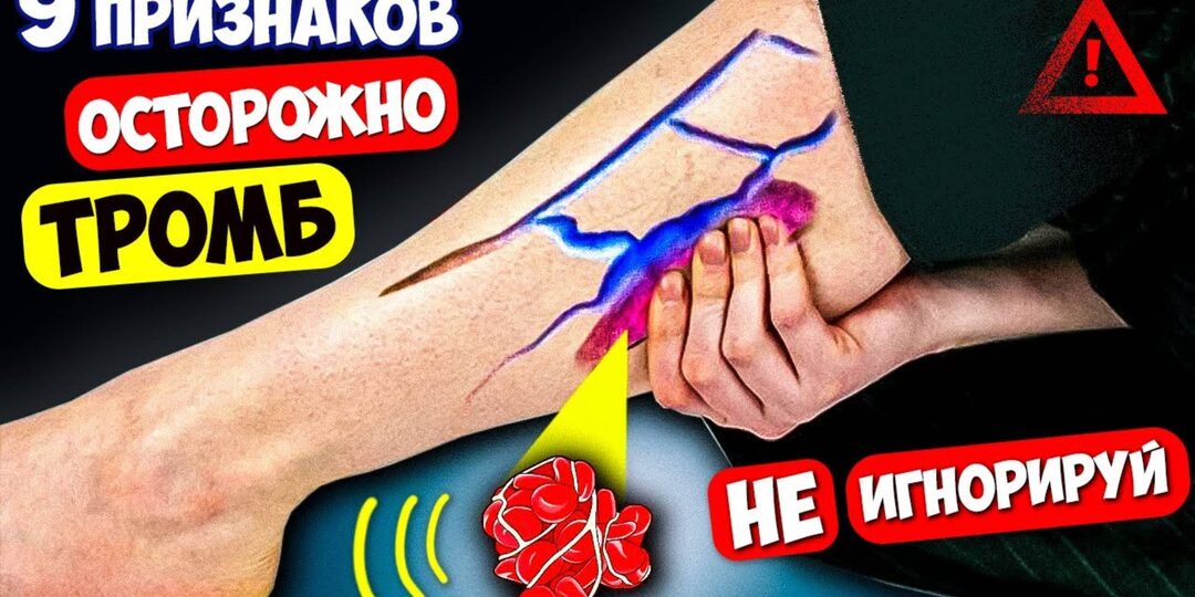 9 cимптомов, что СОСУДЫ закрываются и могут дать Тромб (чек-лист)