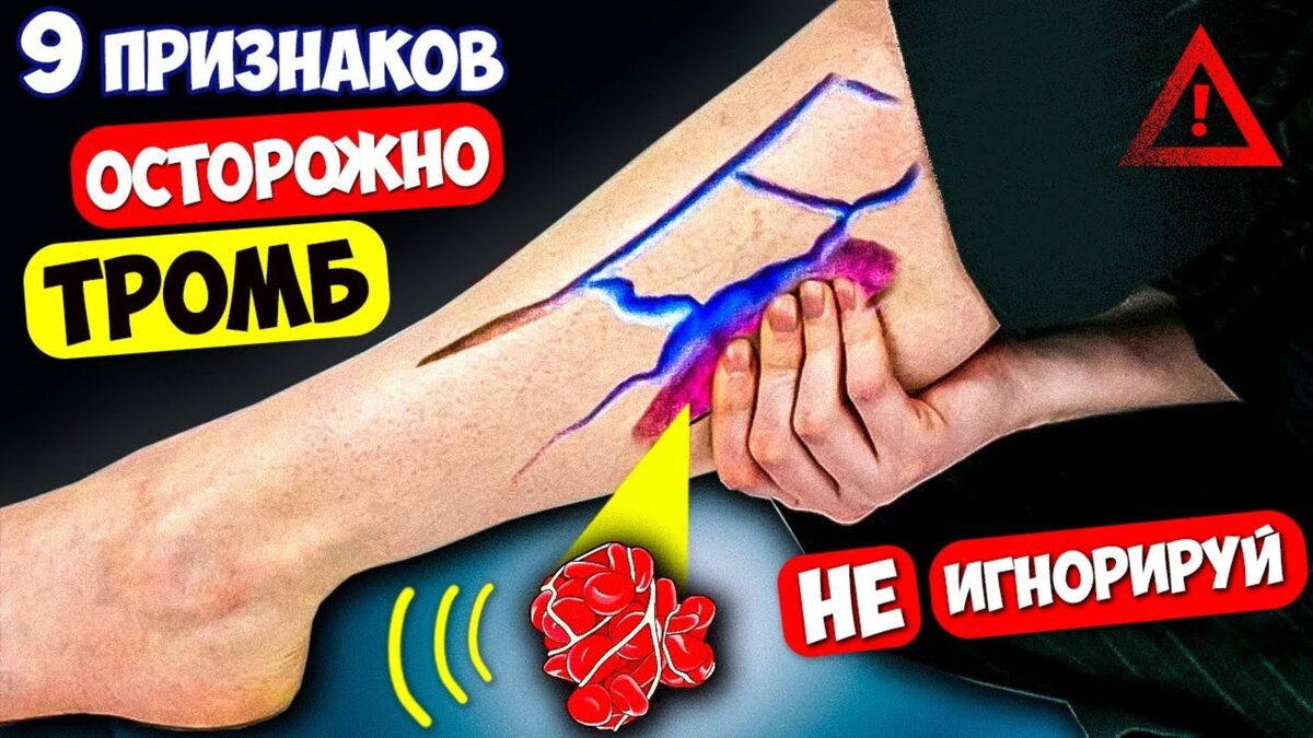 9 Симптомов, Что СОСУДЫ Закрываются И Могут Дать Тромб (чек-лист)