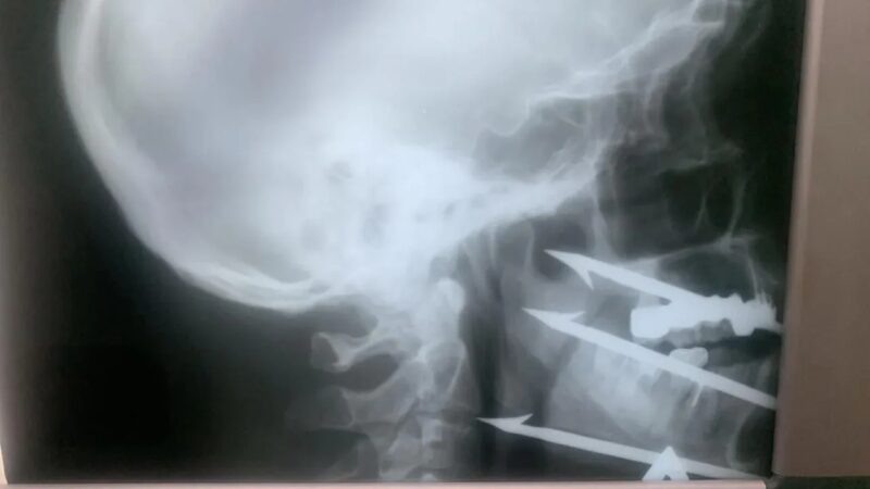    Даже рентген этого ЧП вызывает оторопь