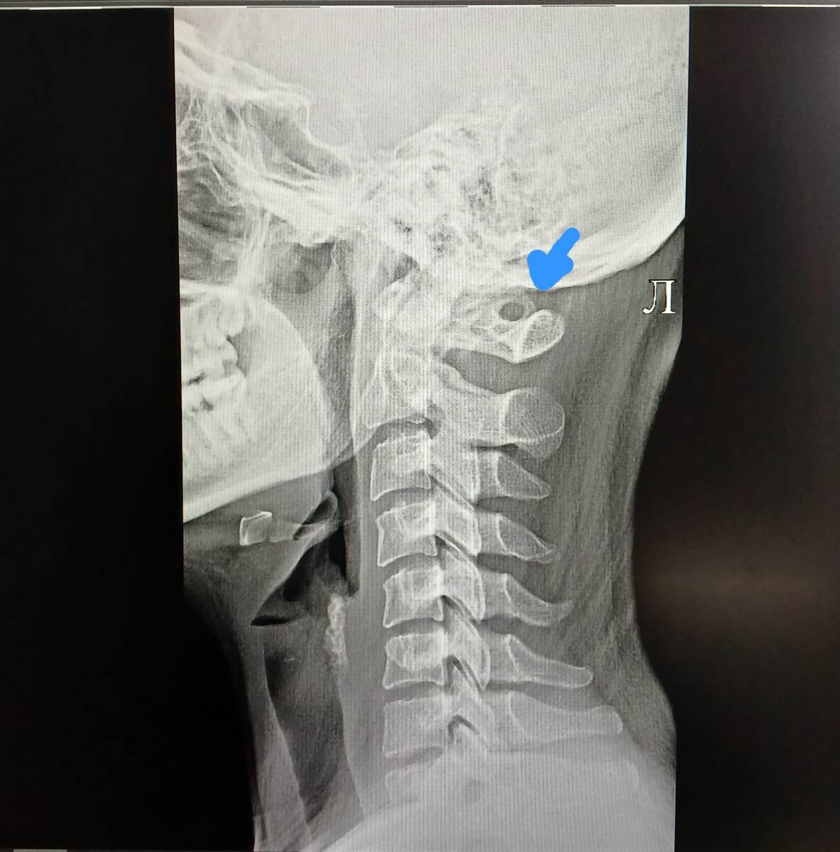 Рентген с аномалией Киммерли