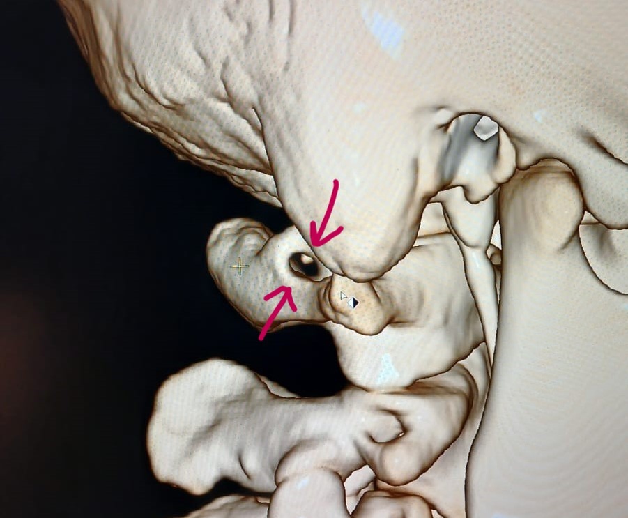 КТ с ангиографией с полной аномалией Киммерли справа, вид сбоку