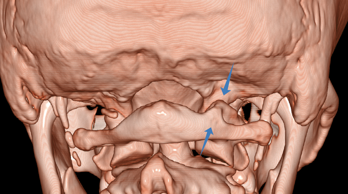 КТ с ангиографией с полной аномалией Киммерли справа, вид сзади